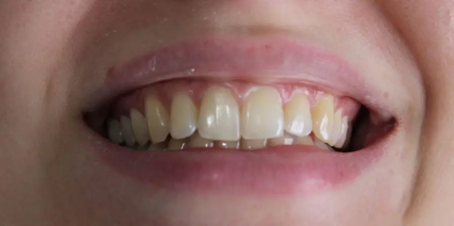 Caso 2: sorriso antes do tratamento