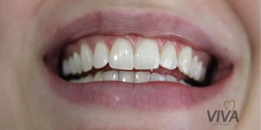 Caso 2: sorriso depois do tratamento