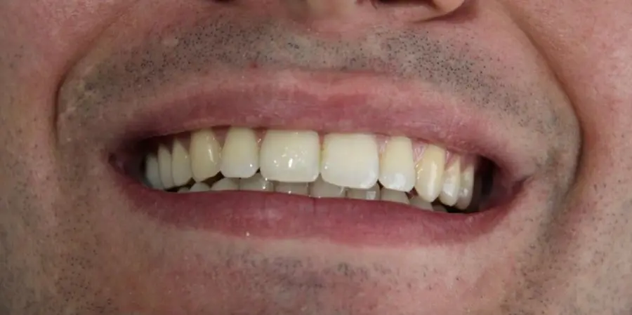 Caso 3: sorriso antes do tratamento