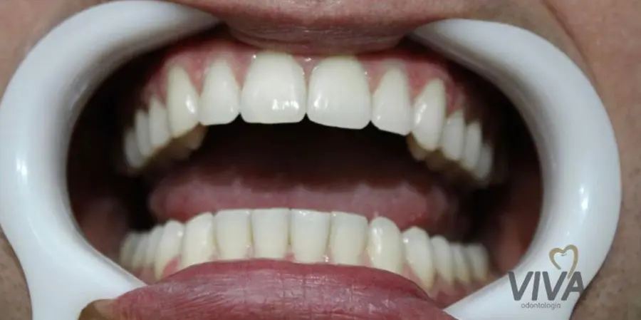 Caso 3: sorriso depois do tratamento