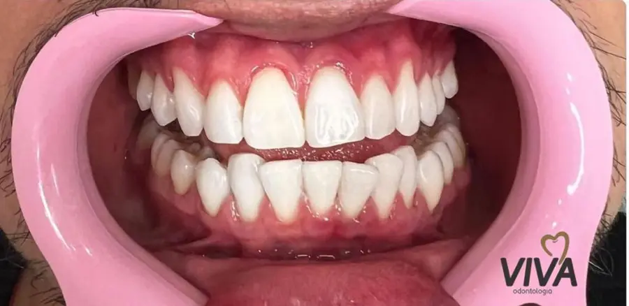 Caso 4: sorriso depois do tratamento